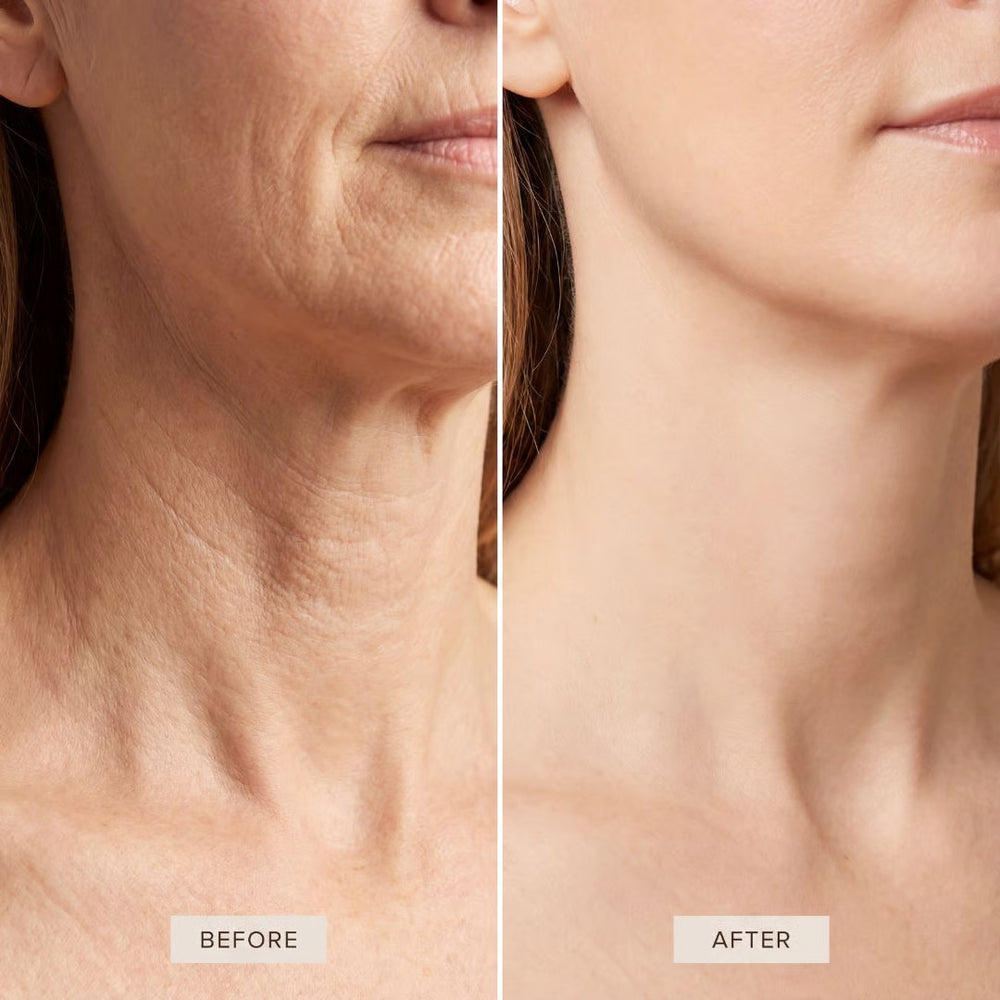2. Fixes Crepey Neck Skin